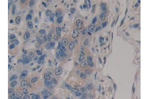 Detection of RSPO3 in Human Breast cancer Tissue using Polyclonal Antibody to R-Spondin 3 (RSPO3)