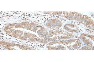 Immunohistochemistry of paraffin-embedded Human liver cancer tissue using USO1 Polyclonal Antibody at dilution of 1:30(x200) (USO1 anticorps)