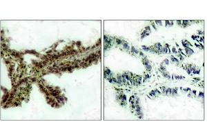 Immunohistochemical analysis of paraffin-embedded human lung carcinoma tissue, using Akt (Phospho-Thr308) Antibody (left) or the same antibody preincubated with blocking peptide (right). (AKT1 anticorps  (pThr308))