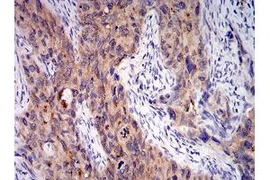 Immunohistochemical analysis of paraffin-embedded cervical cancer tissues using C1QA mouse mAb with DAB staining.