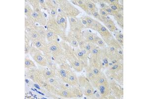 Immunohistochemistry of paraffin-embedded human liver cancer using PON1 antibody (ABIN5975112) at dilution of 1/100 (40x lens). (PON1 anticorps)