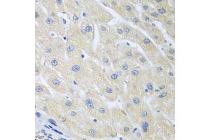 Immunohistochemistry of paraffin-embedded human liver cancer using PON1 antibody (ABIN5975112) at dilution of 1/100 (40x lens). (PON1 anticorps)