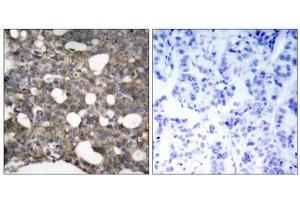 Immunohistochemical analysis of paraffin-embedded human breast carcinoma tissue, using Connexin43 (Ab-367) antibody (E021250). (Connexin 43/GJA1 anticorps)
