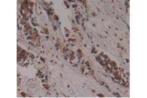 Detection of GDF3 in Human Breast Cancer Tissue using Monoclonal Antibody to Growth Differentiation Factor 3 (GDF3)