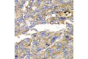 Immunohistochemistry of paraffin-embedded human liver cancer using SLC25A4 antibody (ABIN5970965) at dilution of 1/100 (40x lens). (SLC25A4 anticorps)