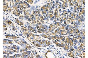 ABIN6264321 and ABIN6278365 at 1/100 staining Human pancreatic cancer and adjacent non-tumor tissue by IHC-P. (PNLIP anticorps  (C-Term))