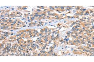Immunohistochemistry of paraffin-embedded Human esophagus cancer tissue using CGB Polyclonal Antibody at dilution 1:60