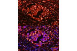 Immunofluorescence analysis of human lung cancer using  Rabbit pAb (ABIN3016195, ABIN3016196, ABIN3016197, ABIN1678542 and ABIN6219616) at dilution of 1:100 (40x lens).