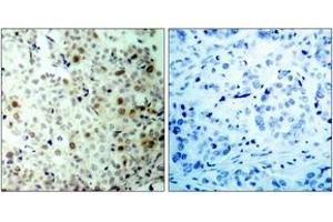 Immunohistochemistry analysis of paraffin-embedded human breast carcinoma, using CDK2 (Phospho-Thr160) Antibody.