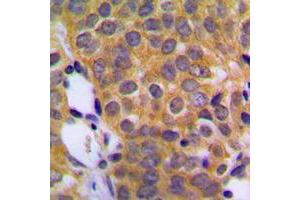 Immunohistochemical analysis of DUSP1 staining in human prostate cancer formalin fixed paraffin embedded tissue section.