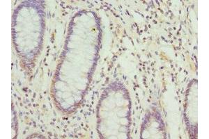 Immunohistochemistry of paraffin-embedded human colon cancer using ABIN7149015 at dilution of 1:100
