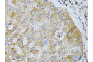 Immunohistochemistry of paraffin-embedded human breast cancer using HDAC8 antibody (ABIN5973443) at dilution of 1/100 (40x lens). (HDAC8 anticorps)