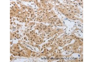 Immunohistochemistry of Human lung cancer using DNAJC7 Polyclonal Antibody at dilution of 1:25 (DNAJC7 anticorps)