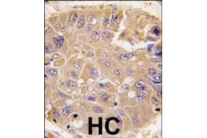 Formalin-fixed and paraffin-embedded human hepatocarcinoma tissue reacted with METAP2 antibody , which was peroxidase-conjugated to the secondary antibody, followed by DAB staining.