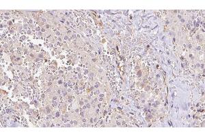 ABIN6273312 at 1/100 staining Human thyroid cancer tissue by IHC-P. (RPS14 anticorps  (Internal Region))