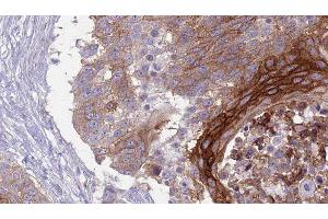 ABIN6277039 at 1/100 staining Human urothelial cancer tissue by IHC-P. (SLAMF1 anticorps  (C-Term))