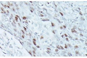 Immunohistochemistry of paraffin-embedded Human breast cancer using MEF2C Polyclonal Antibody at dilution of 1:100 (40x lens).