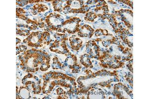 Immunohistochemistry of Human thyroid cancer using BCAT2 Polyclonal Antibody at dilution of 1:70
