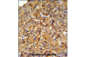 SFT2D3 Antibody IHC analysis in formalin fixed and paraffin embedded human hepatocarcinoma followed by peroxidase conjugation of the secondary antibody and DAB staining. (SFT2D3 anticorps  (N-Term))