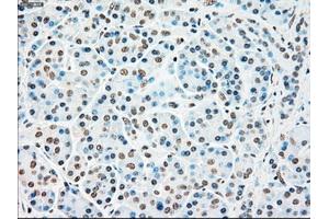 Immunohistochemical staining of paraffin-embedded Adenocarcinoma of colon tissue using anti-STK3mouse monoclonal antibody. (STK3 anticorps)