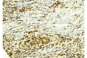 ABIN6278766 at 1/100 staining Human breast cancer tissue by IHC-P. (ZFPM2 anticorps  (C-Term))