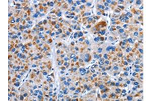 The image on the left is immunohistochemistry of paraffin-embedded Human liver cancer tissue using ABIN7128906(CENPJ Antibody) at dilution 1/40, on the right is treated with fusion protein. (CENPJ anticorps)