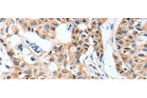 Immunohistochemistry of paraffin-embedded Human lung cancer tissue using P2RY6 Polyclonal Antibody at dilution of 1:40(x200) (P2RY6 anticorps)