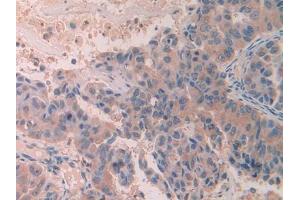 DAB staining on IHC-P; Samples: Human Breast cancer Tissue (SCUBE3 anticorps  (AA 807-993))