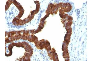 Formalin-fixed, paraffin-embedded human Ovarian Carcinoma stained with Cytokeratin 7 Mouse Monoclonal Antibody (KRT7/1198). (Cytokeratin 7 anticorps)