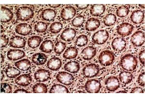 Immunohistochemistry of paraffin-embedded Human colon carcinoma tissue using gamma Tubulin Monoclonal Antibody at dilution of 1:200.