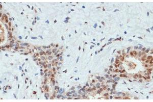 Immunohistochemistry of paraffin-embedded Human breast cancer using Phospho-AKT(S473) Polyclonal Antibody at dilution of 1:200 (40x lens). (AKT1 anticorps  (pSer473))