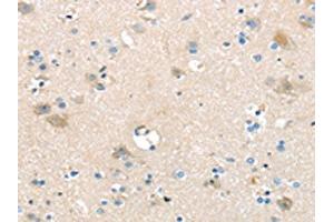 The image on the left is immunohistochemistry of paraffin-embedded Human brain tissue using ABIN7192395(SLC16A11 Antibody) at dilution 1/25, on the right is treated with synthetic peptide. (SLC16A11 anticorps)