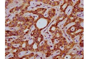 IHC image of ABIN7170110 diluted at 1:200 and staining in paraffin-embedded human liver cancer performed on a Leica BondTM system.