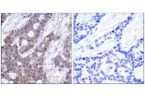 Immunohistochemical analysis of paraffin-embedded human breast carcinoma tissue, using Stathmin 1 (phospho-Ser15) antibody (E011234). (Stathmin 1 anticorps  (pSer15))