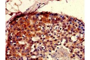 Immunohistochemistry of paraffin-embedded human breast cancer using ABIN7168659 at dilution of 1:100