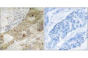 Immunohistochemistry analysis of paraffin-embedded human colon carcinoma, using ATRIP (Phospho-Ser224) Antibody. (ATRIP anticorps  (pSer224))