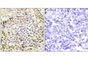Immunohistochemistry analysis of paraffin-embedded human lung carcinoma tissue using IRX2 antibody. (IRX2 anticorps  (Internal Region))