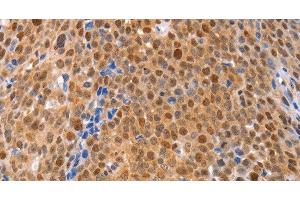 Immunohistochemistry of paraffin-embedded Human ovarian cancer using MKP-2 Polyclonal Antibody at dilution of 1:30