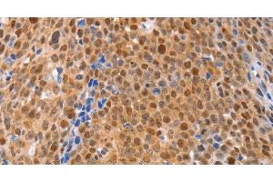 Immunohistochemistry of paraffin-embedded Human ovarian cancer using MKP-2 Polyclonal Antibody at dilution of 1:30 (DUSP4 anticorps)