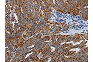 The image on the left is immunohistochemistry of paraffin-embedded Human ovarian cancer tissue using ABIN7192612(SPAG1 Antibody) at dilution 1/25, on the right is treated with synthetic peptide. (SPAG1 anticorps)