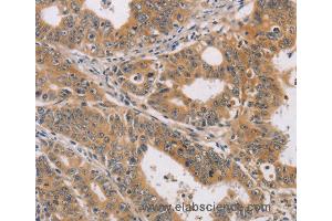 Immunohistochemistry of Human gastric cancer using CDK11A/CDK11B Polyclonal Antibody at dilution of 1:40 (CDK11 anticorps)