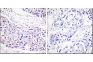 Immunohistochemistry analysis of paraffin-embedded human breast carcinoma tissue, using p90 RSK (Ab-359/363) Antibody. (RPS6KA3 anticorps  (AA 331-380))