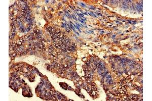 Immunohistochemistry of paraffin-embedded human colon cancer using ABIN7147936 at dilution of 1:100 (CLASP2 anticorps  (AA 226-381))