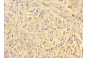 Immunohistochemistry of paraffin-embedded human melanoma using ABIN7151102 at dilution of 1:100 (Pellino 3 anticorps  (AA 1-280))
