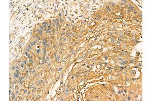 ABIN7094517 and ABIN7098566 at 1/100 staining Human esophageal cancer by IHC-P.