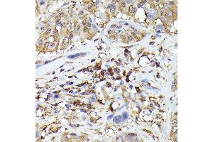 Immunohistochemistry of paraffin-embedded human esophageal cancer using ASC/TMS1 Rabbit pAb (ABIN7269756) at dilution of 1:200 (40x lens). (PYCARD anticorps)