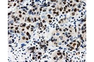 Immunohistochemical staining of paraffin-embedded Adenocarcinoma of breast tissue using anti-CISD1 mouse monoclonal antibody.