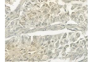 ABIN6257324 and ABIN6273467 at 1/100 staining human lung squamous cell carcinoma by IHC-P. (MLF1IP anticorps  (N-Term))
