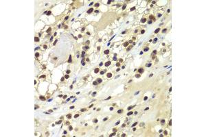 Immunohistochemistry of paraffin-embedded human kidney cancer using PRKDC antibody (ABIN5975861) at dilution of 1/100 (40x lens). (PRKDC anticorps)