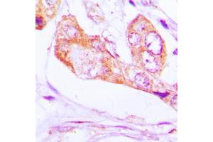 Immunohistochemical analysis of PNPT1 staining in human lung cancer formalin fixed paraffin embedded tissue section. (PNPT1 anticorps  (C-Term))